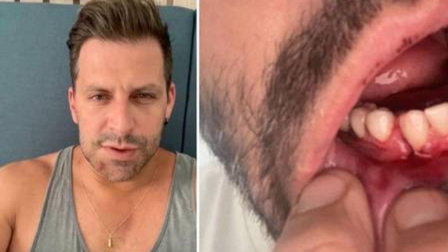Henri Castelli mostra tratamento na boca após agressão