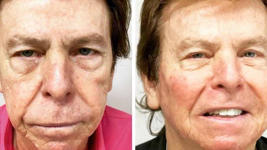 Nelson Rubens mostra resultado de harmonização facial: 