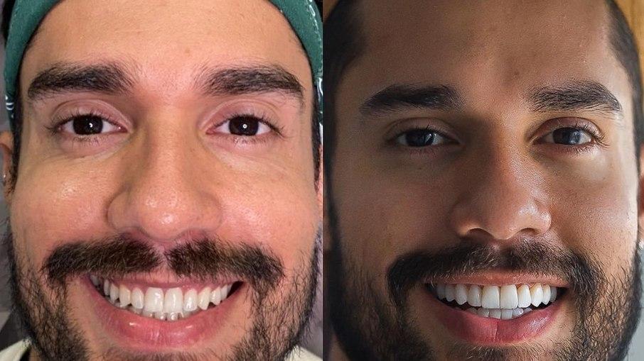 Ex-BBB Arcrebiano coloca lentes de porcelana nos dentes; veja o resultado