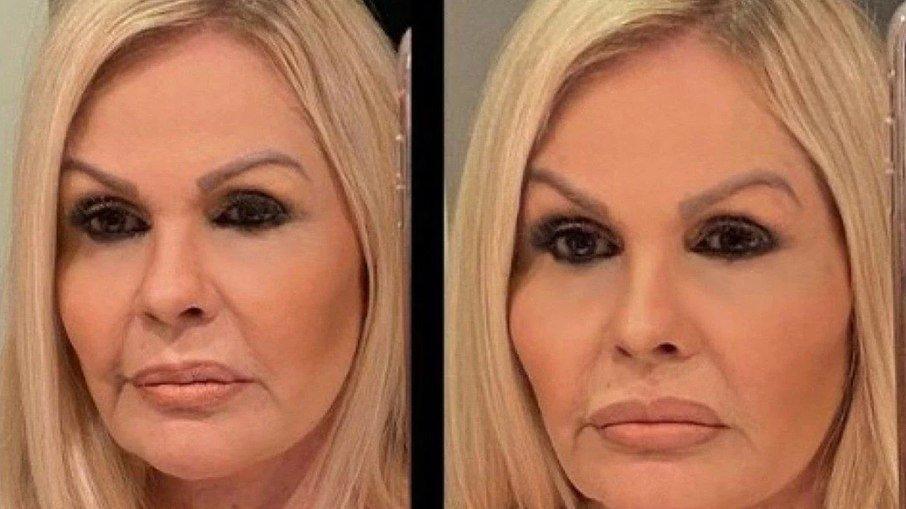 Monique Evans mostra antes e depois de harmonização facial