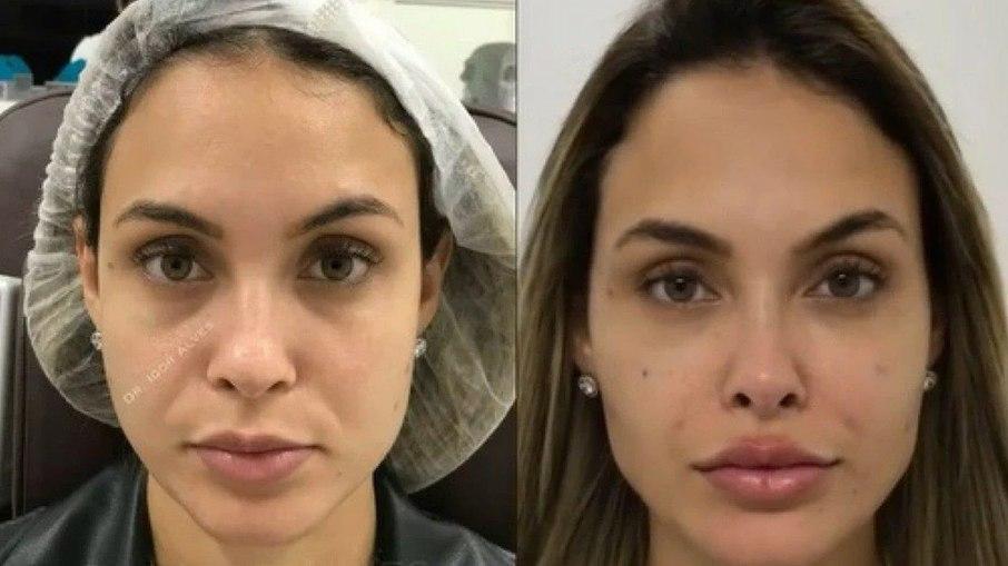 'BBB 21': Sarah Andrade decide mexer no rosto e médico mostra o antes e depois