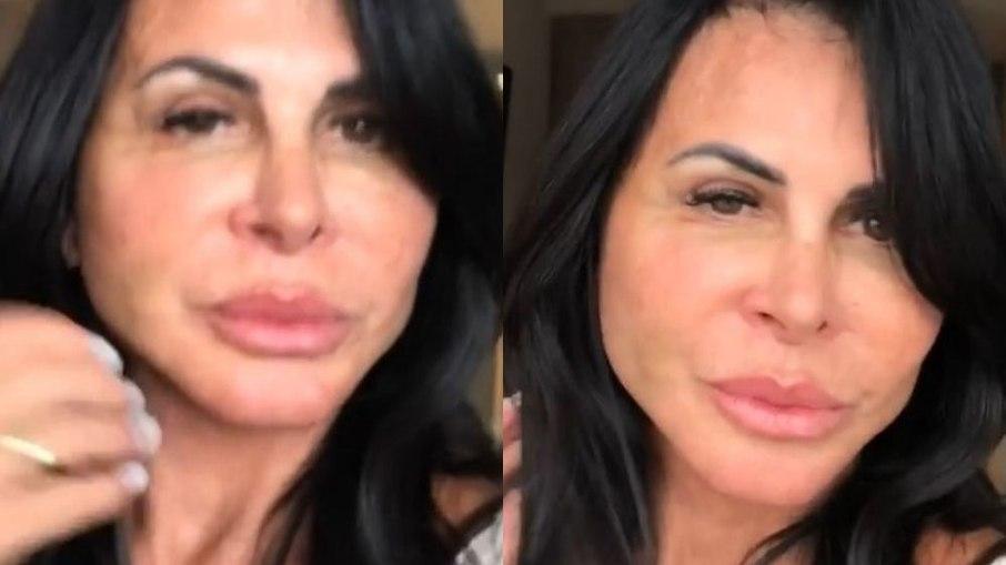 Gretchen mostra resultado de procedimento estético