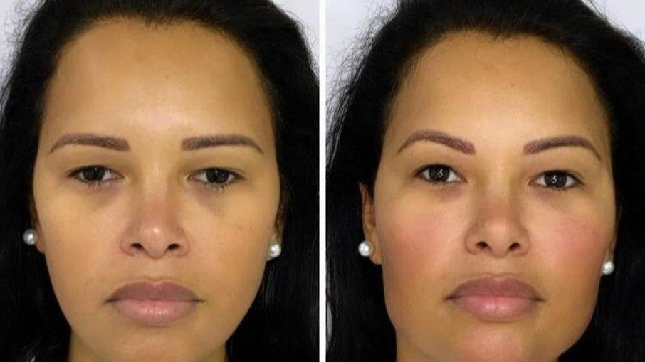 Ariadna Arantes faz harmonização facial para 'marcar mandíbula'; veja resultado