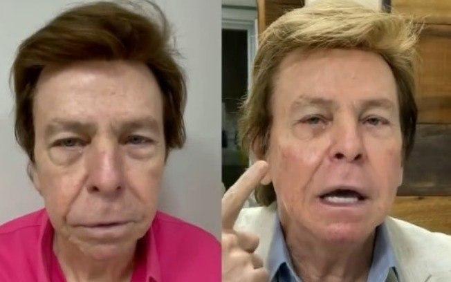 Nelson Rubens entra na onda de harmonização facial; confira o antes e depois