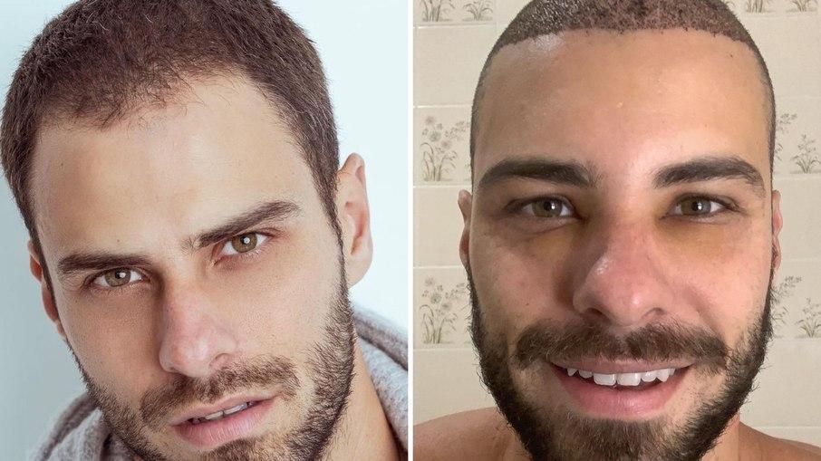 Lucas Malvacini se diz realizado após transplante capilar: 