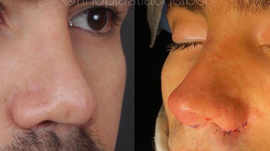 Mariano mostra antes e depois de cirurgia no nariz após decepção e surpreende