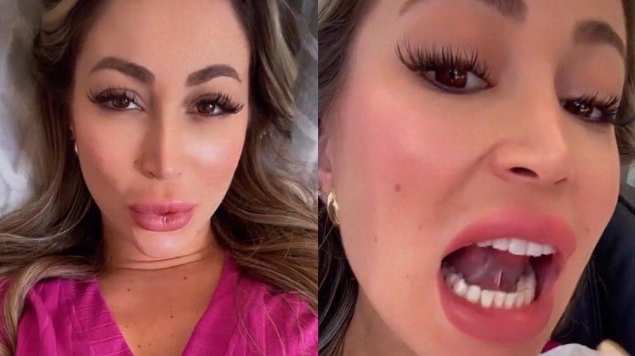 Carol Narizinho faz cirurgia para corrigir língua presa: 