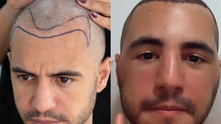 Ex-BBB Matheus Lisboa surge com rosto inchado após transplante capilar