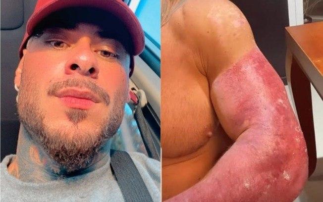 Leo Stronda mostra braço machucado após acidente com botijão de gás