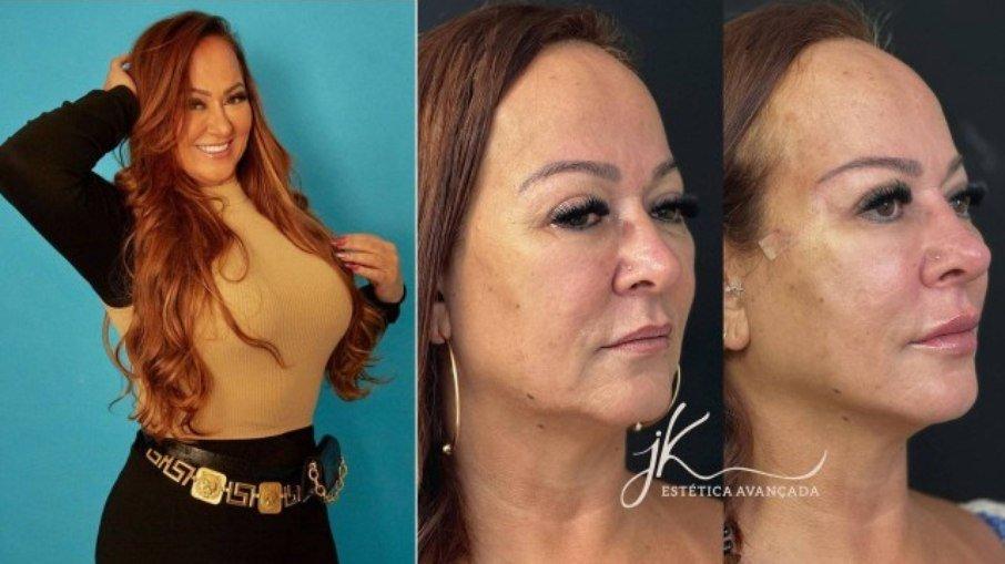 Mãe de Neymar faz 6 procedimentos estéticos no rosto de uma vez