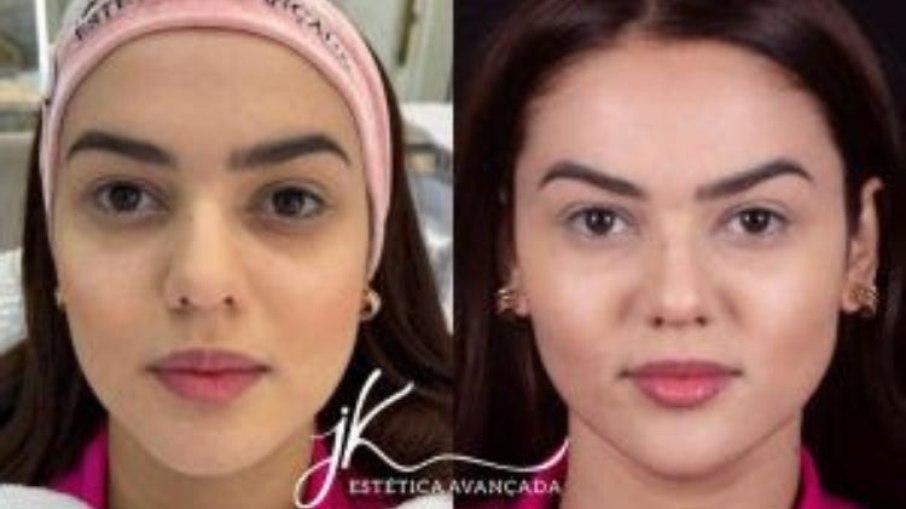 Eslovênia faz harmonização facial; veja antes e depois