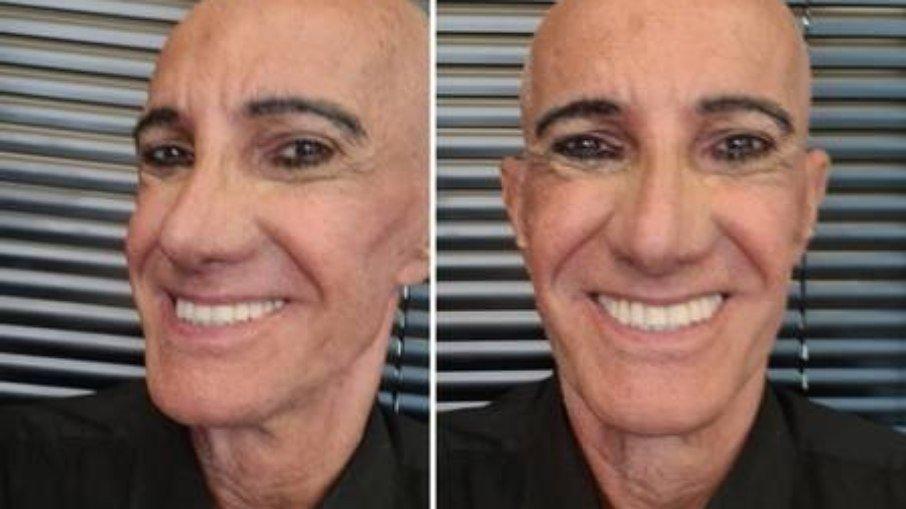 Amin Khader mostra resultado de cirurgia 'Parecido com o Luciano Huck'