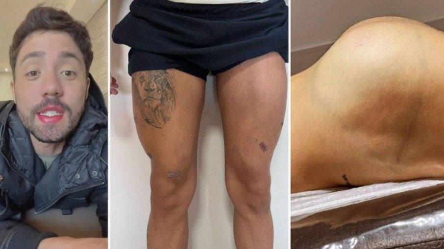 Rico Melquiades coloca preenchimento na coxa e no bumbum; veja fotos