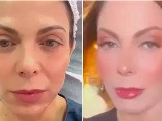 Sheila Mello mostra antes e depois do retoque de Botox