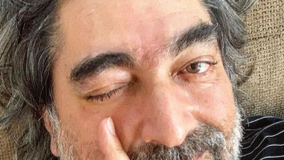 Zeca Camargo atualiza estado de saúde após cirurgia de emergência